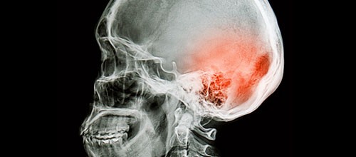 La commotion cérébrale et l’ostéopathie